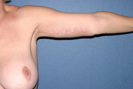Arm Lift Before & After Patient #1052