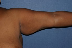 Arm Lift Before & After Patient #1043