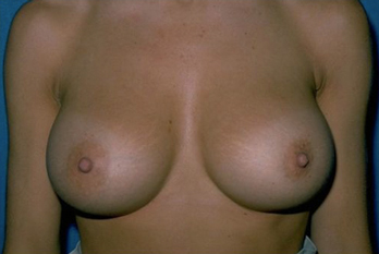 Breast Before & After Patient #971