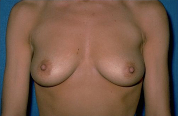 Breast Before & After Patient #971