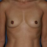 Breast Augmentation Before & After Patient #1026