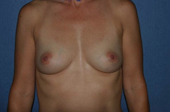 Breast Augmentation Before & After Patient #1029