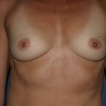 Breast Augmentation Before & After Patient #991