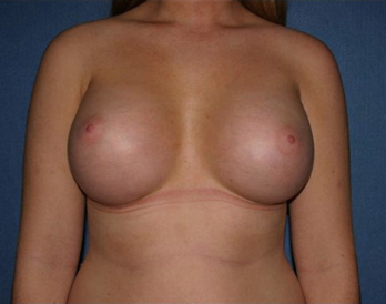 Breast Augmentation Before & After Patient #1005