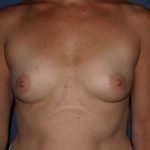 Breast Augmentation Before & After Patient #1012