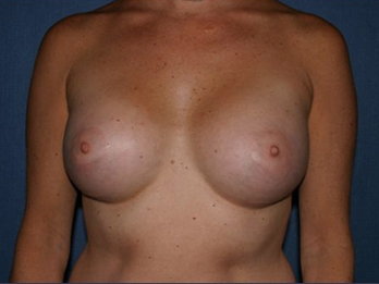 Breast Augmentation Before & After Patient #1012