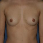 Breast Augmentation Before & After Patient #1019