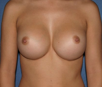 Breast Augmentation Before & After Patient #1019