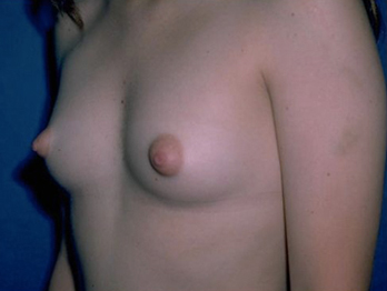 Breast Augmentation Before & After Patient #981