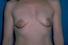 Breast Lift (Mastopexy) Before & After Patient #593