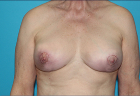 Breast Lift (Mastopexy) Before & After Patient #610