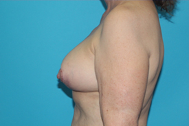 Breast Lift (Mastopexy) Before & After Patient #610