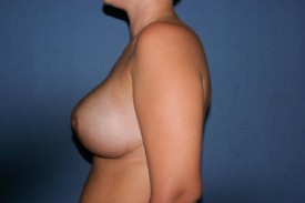 Breast Lift (Mastopexy) Before & After Patient #582