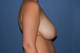 Breast Lift (Mastopexy) Before & After Patient #582