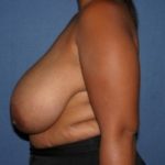Breast Reduction Before & After Patient #1036