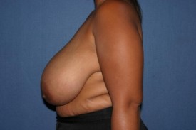 Breast Reduction Before & After Patient #1036