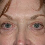 Eyelid Lift Before & After Patient #1141