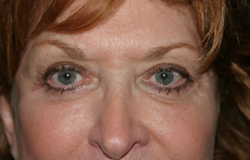 Eyelid Lift Before & After Patient #1141