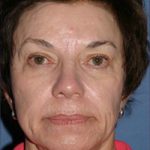 Facelift Before & After Patient #333