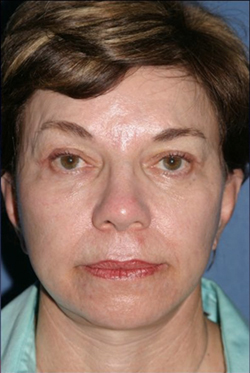 Facelift Before & After Patient #333