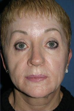 Facelift Before & After Patient #336