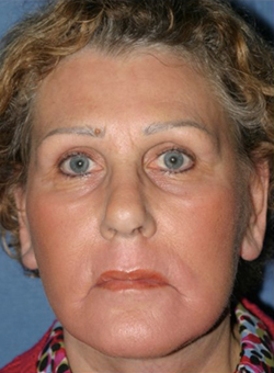 Facelift Before & After Patient #341