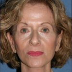 Facelift Before & After Patient #358