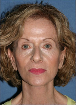 Facelift Before & After Patient #358