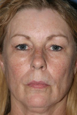 Facelift Before & After Patient #287