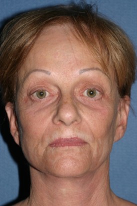 Facelift Before & After Patient #454