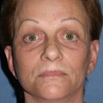 Facelift Before & After Patient #454