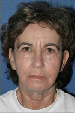 Facelift Before & After Patient #306