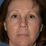 Facelift Before & After Patient #309