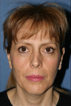 Facelift Before & After Patient #312