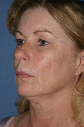 Facelift Before & After Patient #287