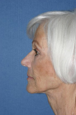 Facelift Before & After Patient #366