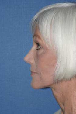 Facelift Before & After Patient #366