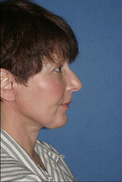 Facelift Before & After Patient #294