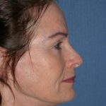 Facelift Before & After Patient #465