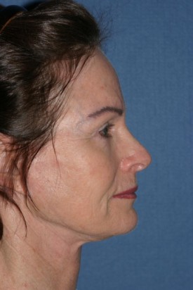 Facelift Before & After Patient #465
