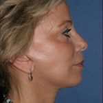 Facelift Before & After Patient #301