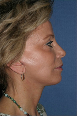 Facelift Before & After Patient #301