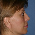 Facelift Before & After Patient #312
