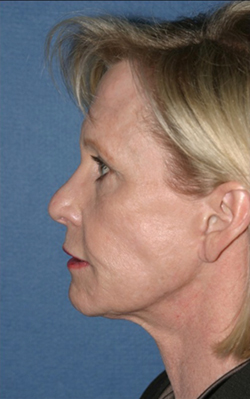Facelift Before & After Patient #320