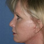 Facelift Before & After Patient #320