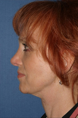 Facelift Before & After Patient #327