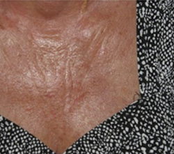 Skin Before & After Patient #1079