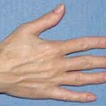 Hand Rejuvenation Before & After Patient #851