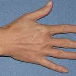 Hand Rejuvenation Before & After Patient #851