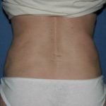 Power Assisted Liposuction Before & After Patient #1088
